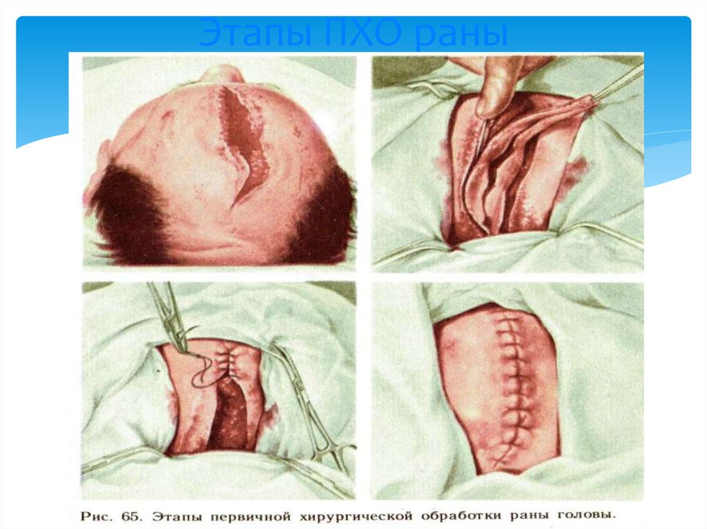 Этапы ПХО раны