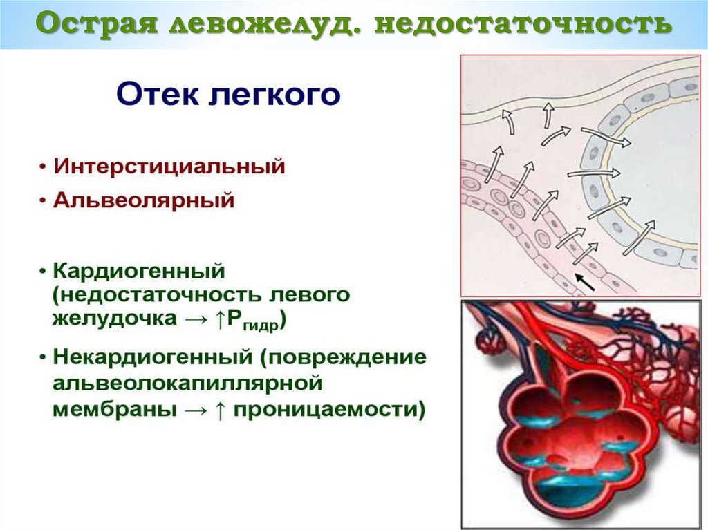 Острая левожелуд. недостаточность