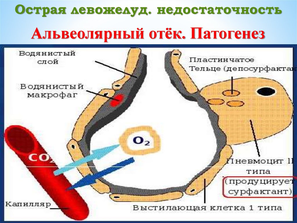 Острая левожелуд. недостаточность