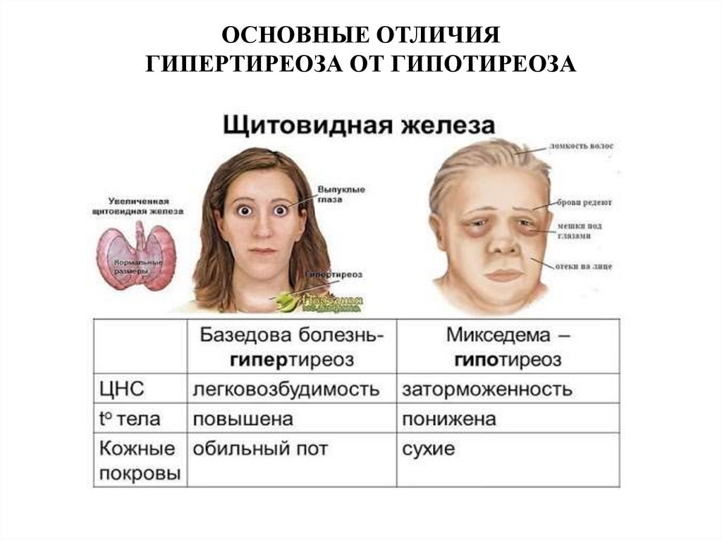 ОСНОВНЫЕ ОТЛИЧИЯ ГИПЕРТИРЕОЗА ОТ ГИПОТИРЕОЗА