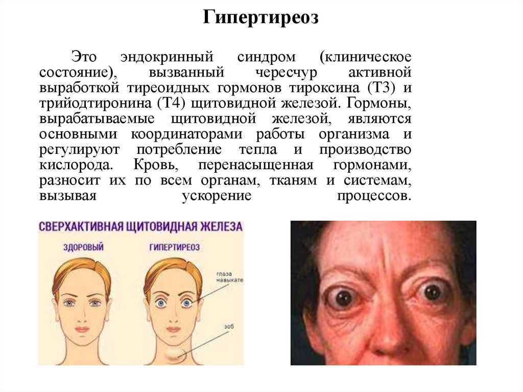 Гипертиреоз