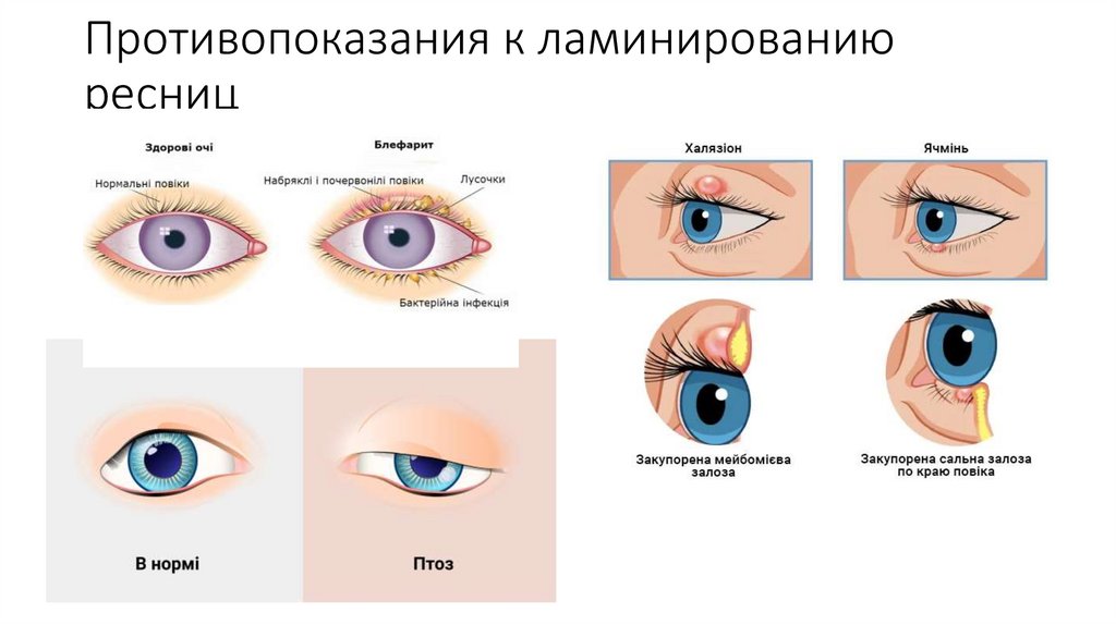 Противопоказання до ламінування вій