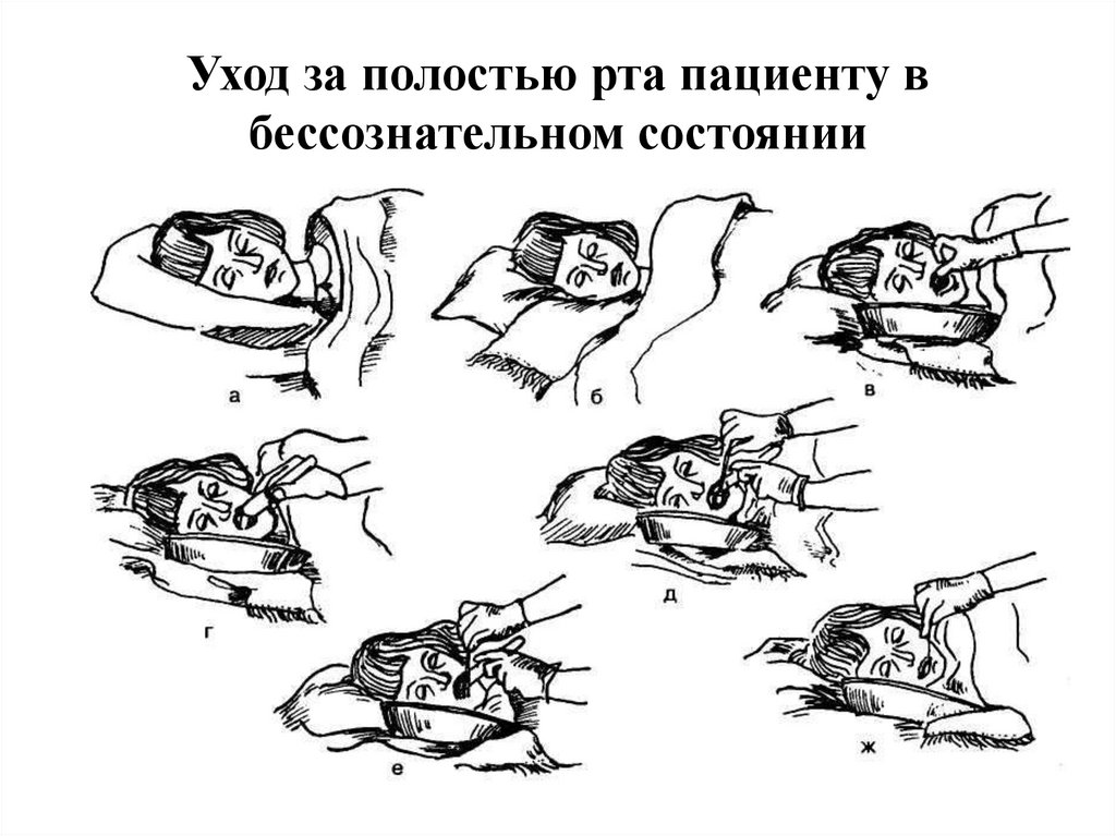 Уход за полостью рта пациенту в бессознательном состоянии