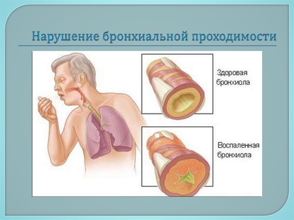 Нарушение бронхиальной проходимости