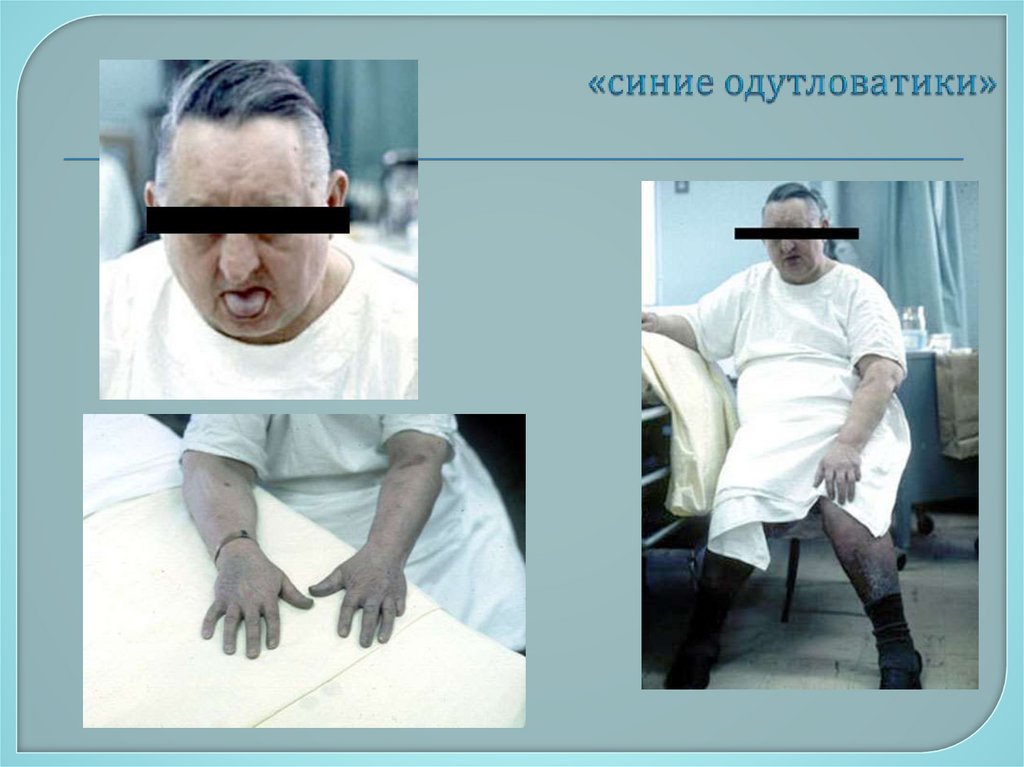 «синие одутловатики»