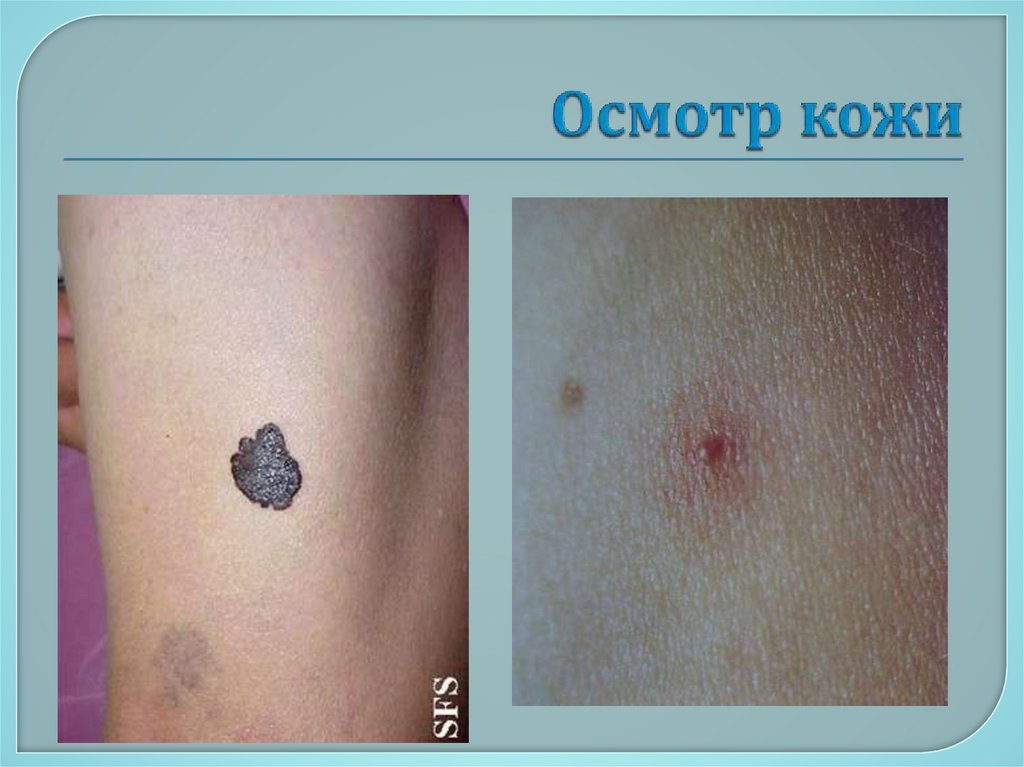 Осмотр кожи