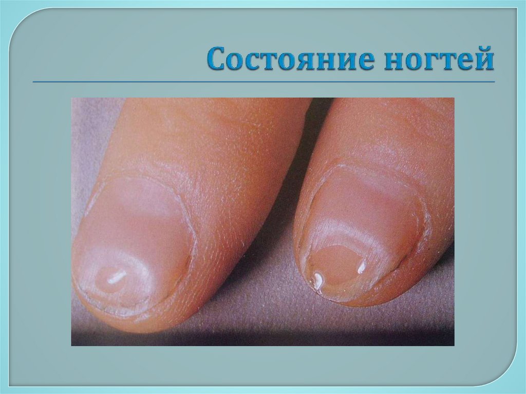 Состояние ногтей
