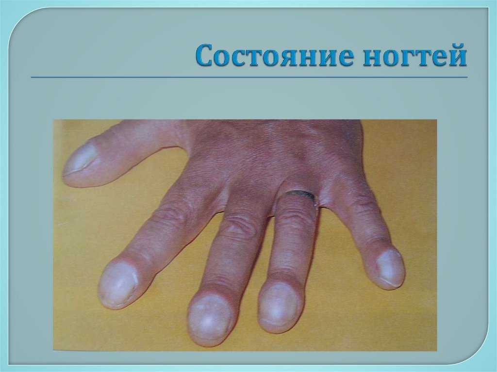 Состояние ногтей