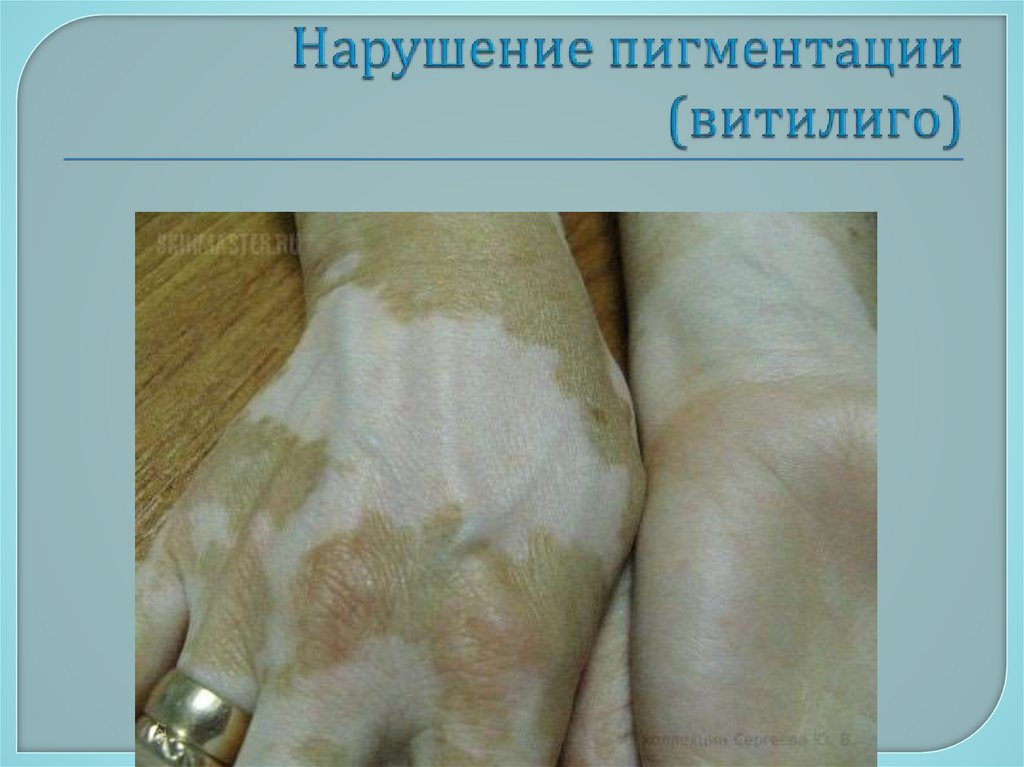 Нарушение пигментации (витилиго)