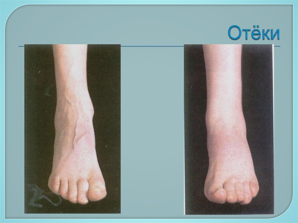 Отёки