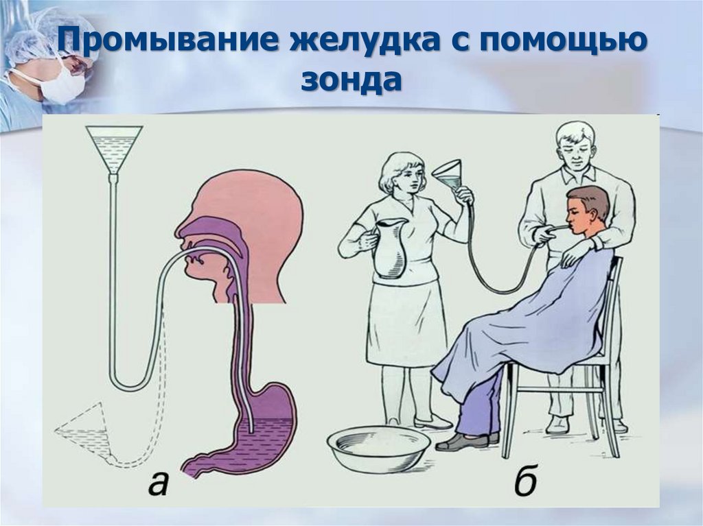 Промывание желудка с помощью зонда