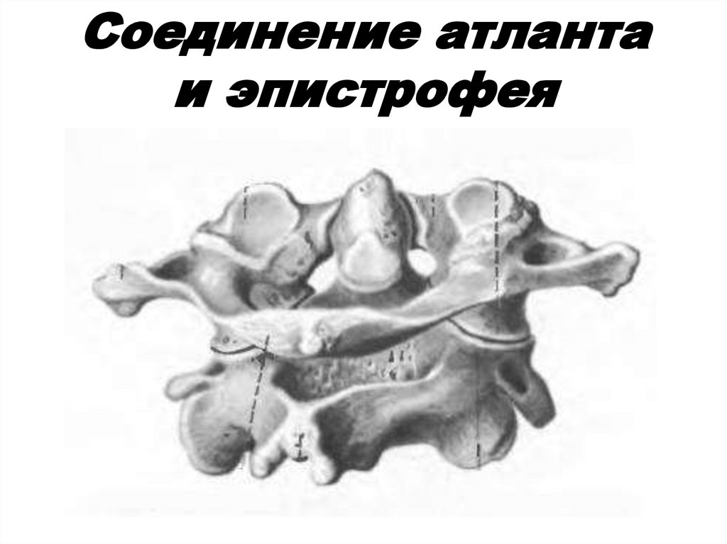 Соединение атланта и эпистрофея
