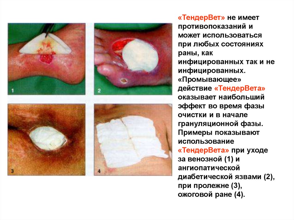 «ТендерВет» не имеет противопоказаний и может использоваться при любых состояниях раны, как инфицированных так и не