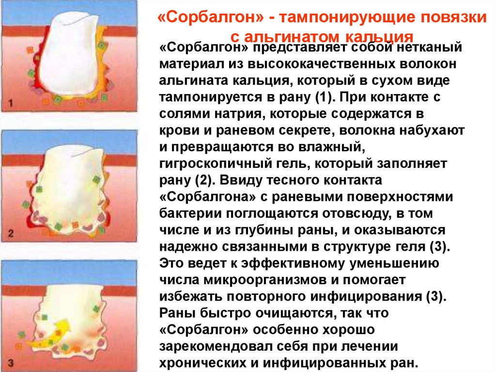 «Сорбалгон» - тампонирующие повязки с альгинатом кальция