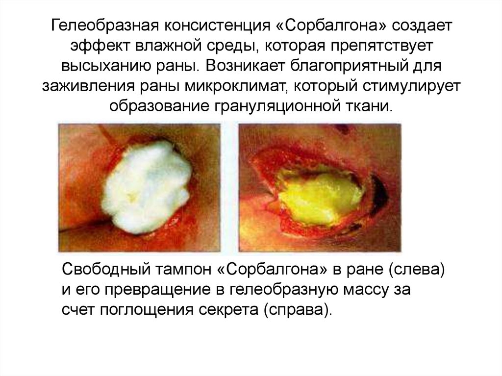 Гелеобразная консистенция «Сорбалгона» создает эффект влажной среды, которая препятствует высыханию раны. Возникает