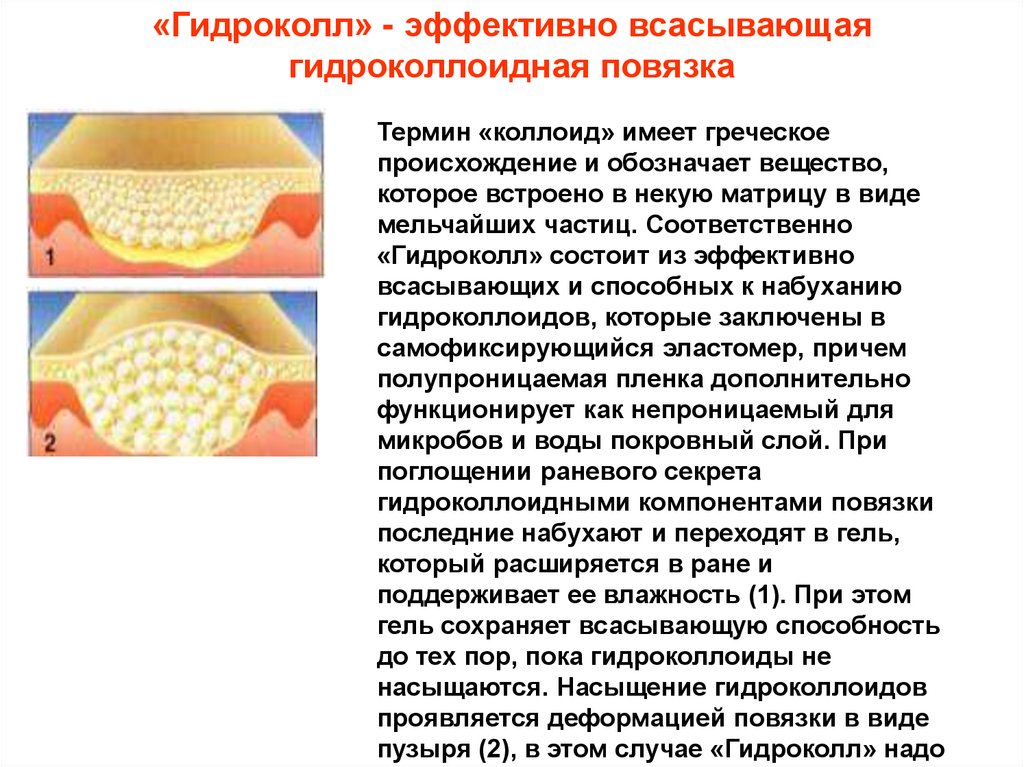 «Гидроколл» - эффективно всасывающая гидроколлоидная повязка