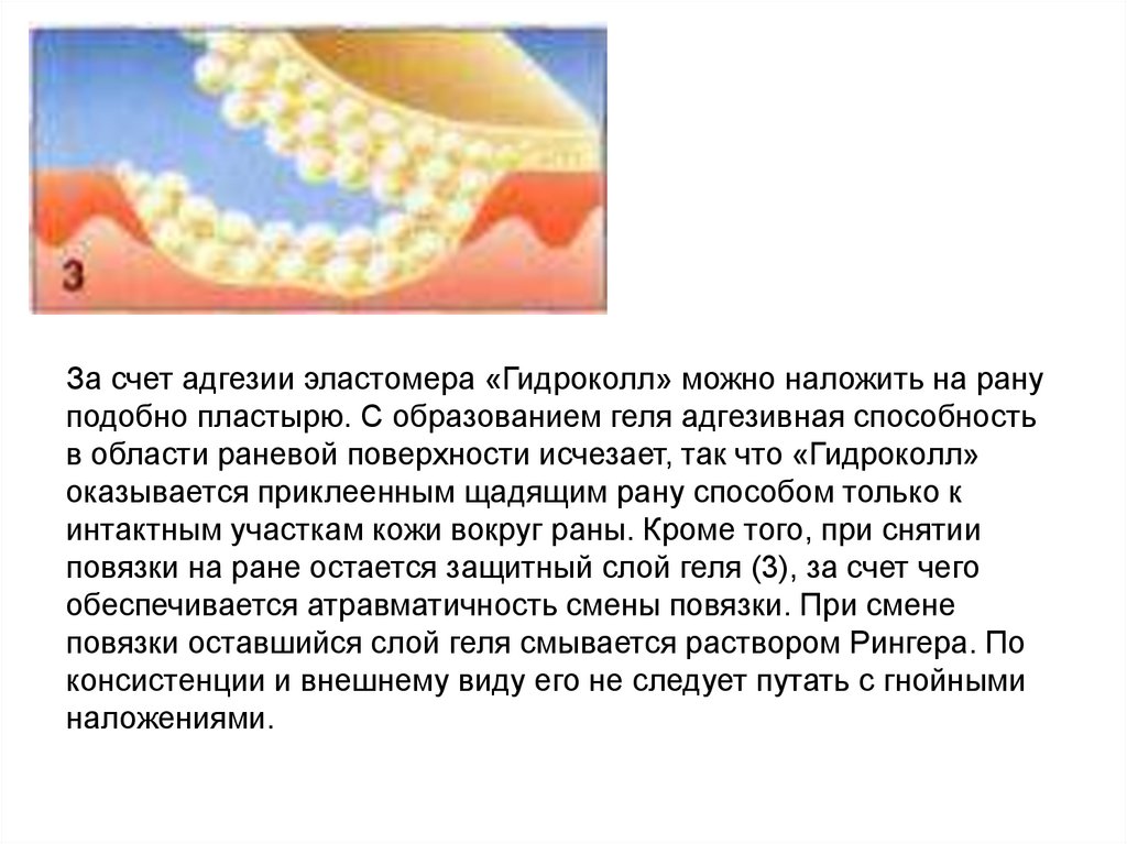 За счет адгезии эластомера «Гидроколл» можно наложить на рану подобно пластырю. С образованием геля адгезивная способность в