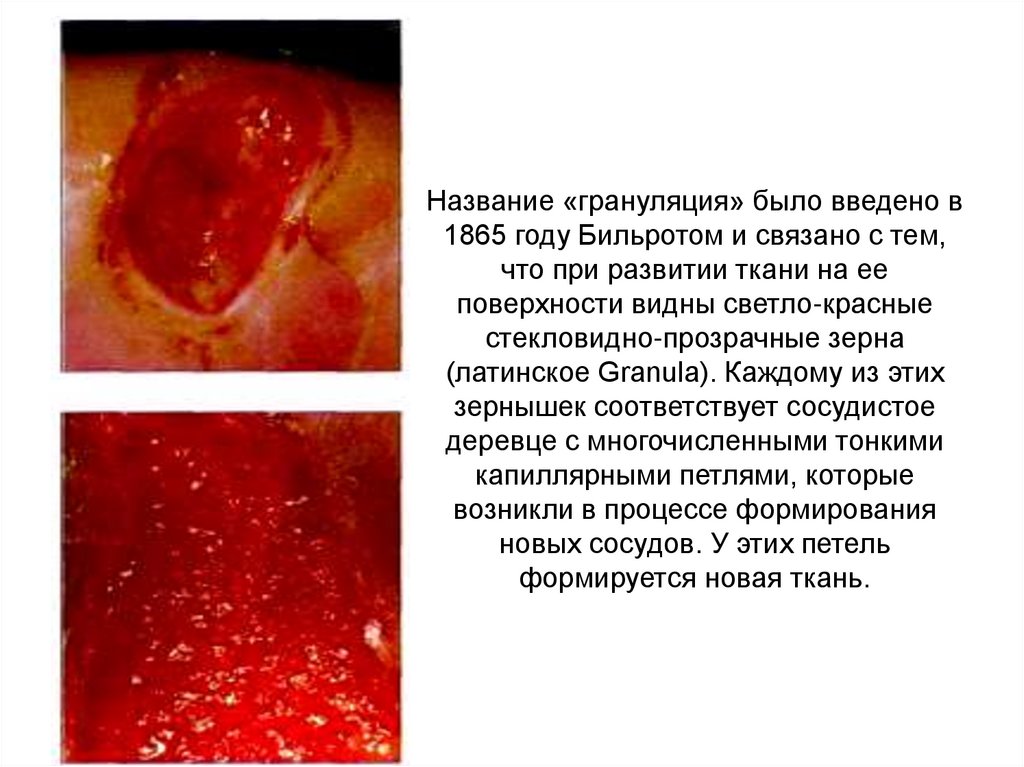 Название «грануляция» было введено в 1865 году Бильротом и связано с тем, что при развитии ткани на ее поверхности видны