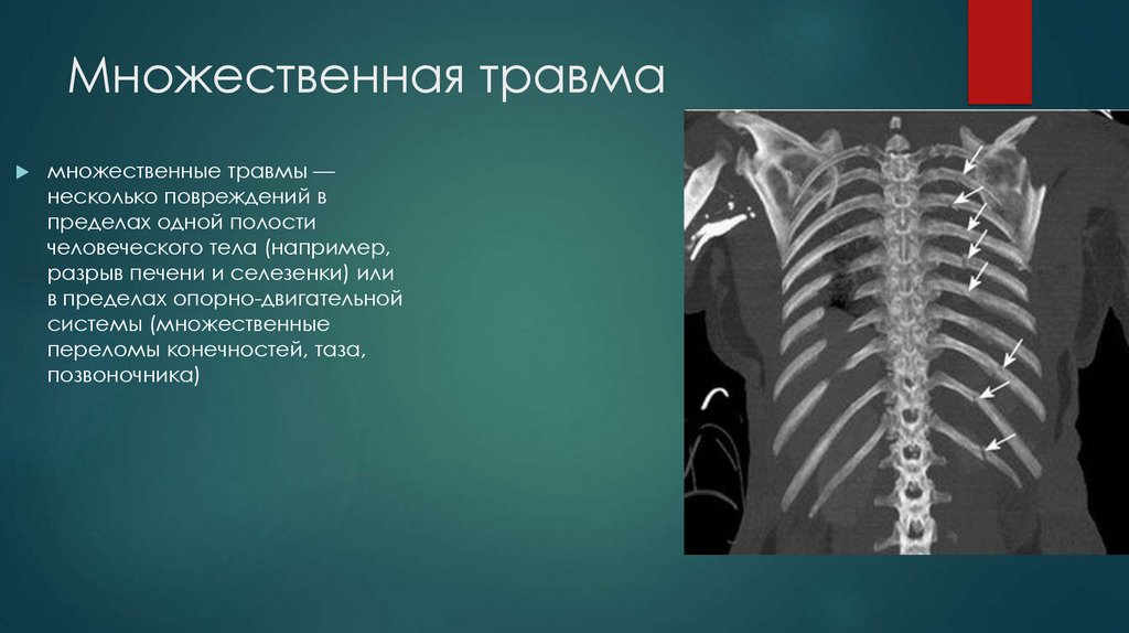 Множественная травма