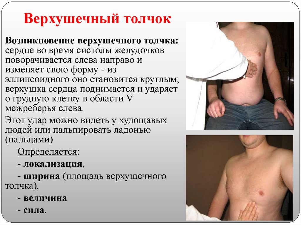 Верхушечный толчок