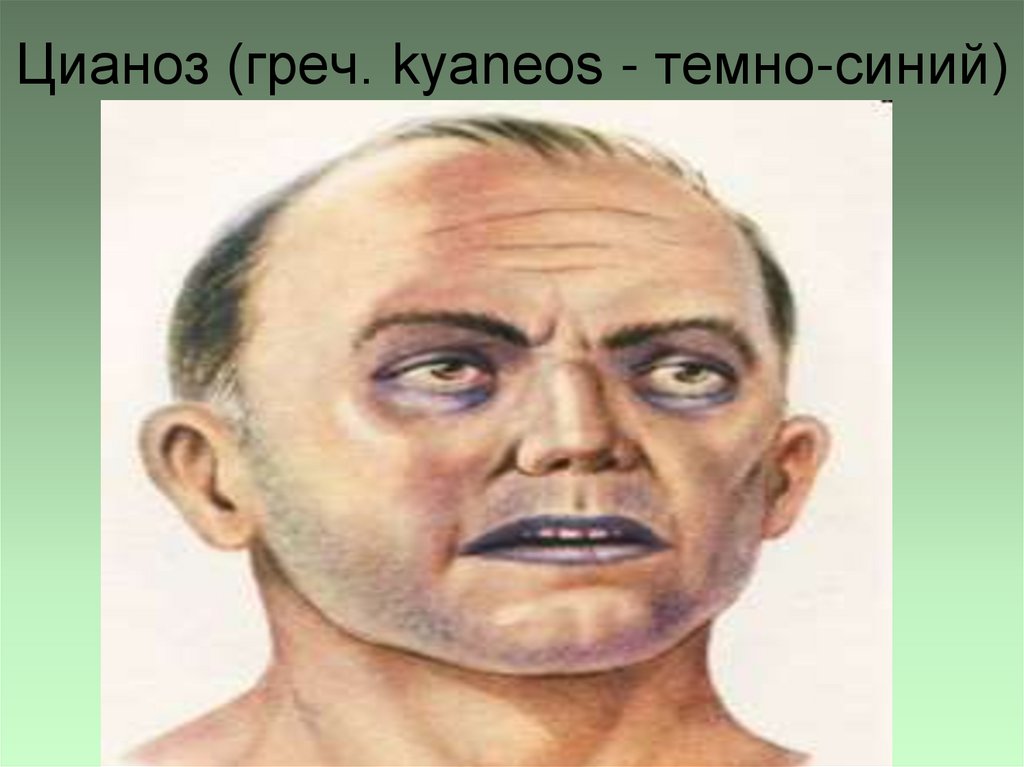 Цианоз (греч. kyaneos - темно-синий)