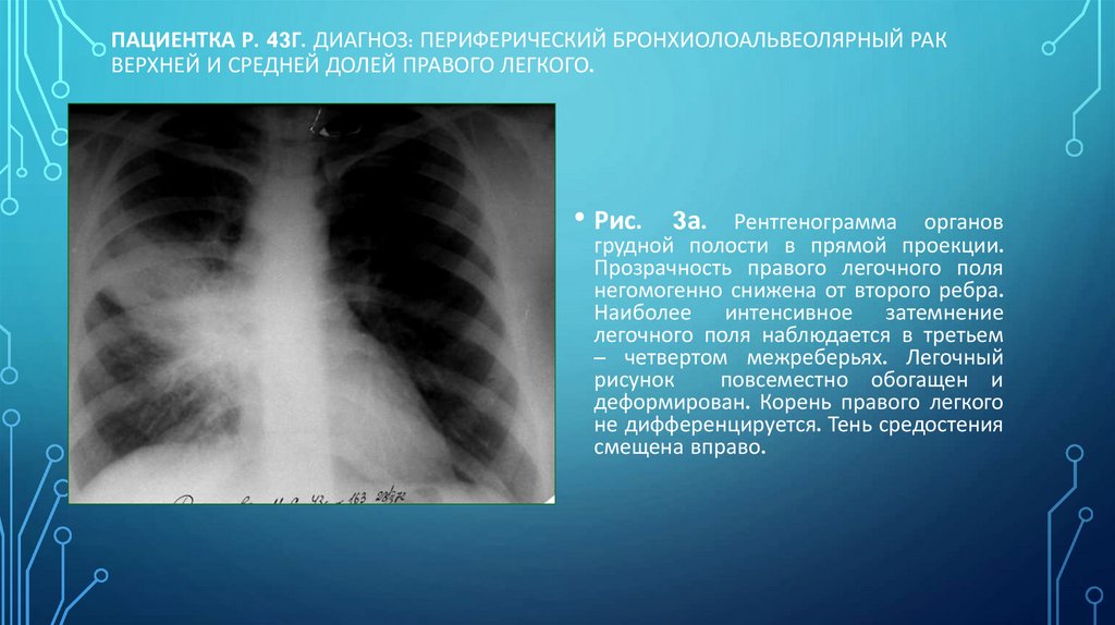Пациентка Р. 43г. Диагноз: Периферический бронхиолоальвеолярный рак верхней и средней долей правого легкого.