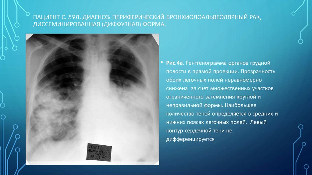 Пациент С. 59л. Диагноз: Периферический бронхиолоальвеолярный рак, диссеминированная (диффузная) форма.