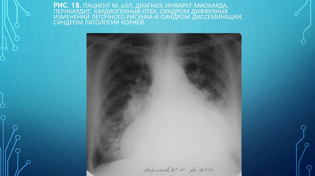 Рис. 18. Пациент М. 65л. Диагноз: Инфаркт миокарда. Перикардит. Кардиогенный отек. Синдром диффузных изменений легочного