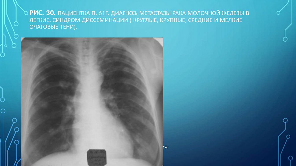 Рис. 30. Пациентка П. 61г. Диагноз: Метастазы рака молочной железы в легкие. Синдром диссеминации ( круглые, крупные, средние и