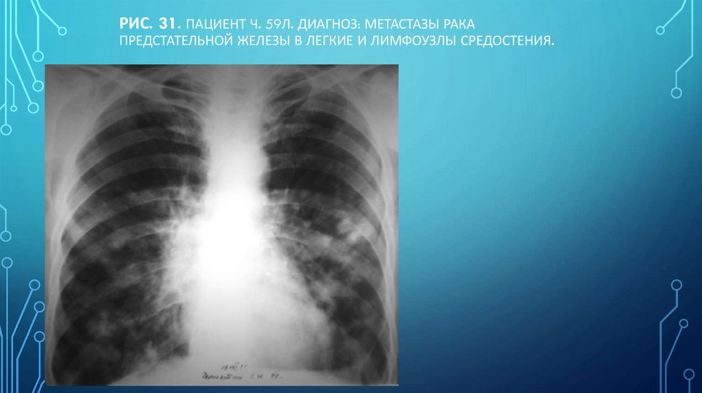 Рис. 31. Пациент Ч. 59л. Диагноз: Метастазы рака предстательной железы в легкие и лимфоузлы средостения.