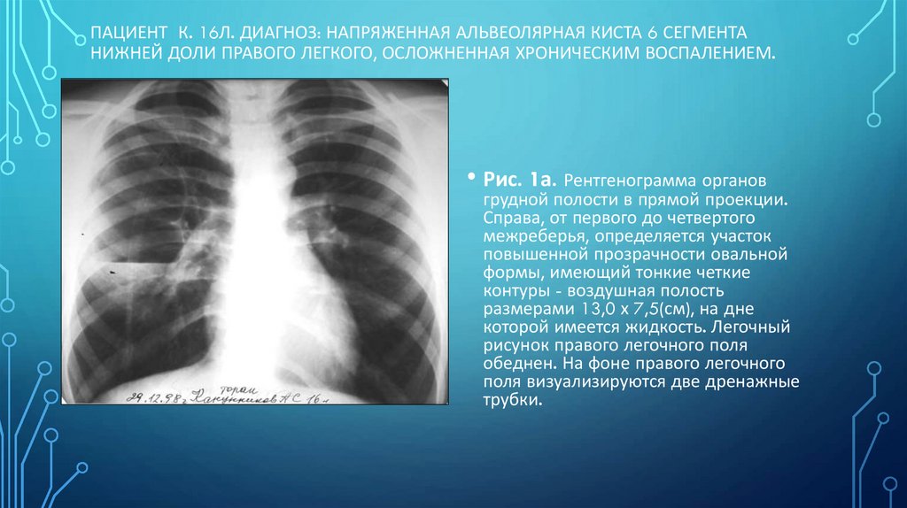 Пациент К. 16л. Диагноз: Напряженная альвеолярная киста 6 сегмента нижней доли правого легкого, осложненная хроническим
