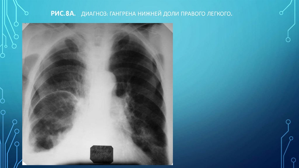 Рис.8а. Диагноз: Гангрена нижней доли правого легкого.