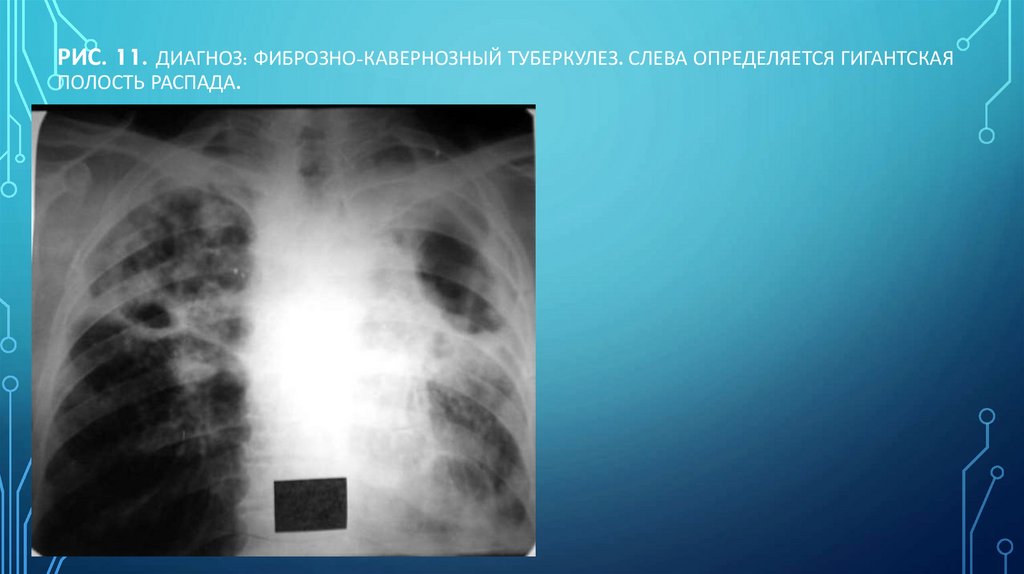 Рис. 11. Диагноз: Фиброзно-кавернозный туберкулез. Слева определяется гигантская полость распада.