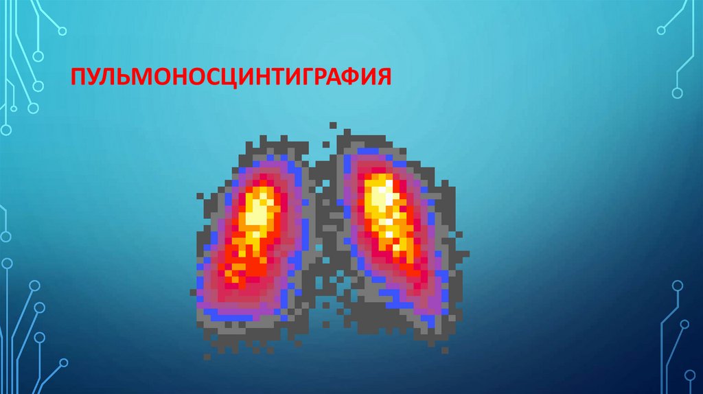 Пульмоносцинтиграфия