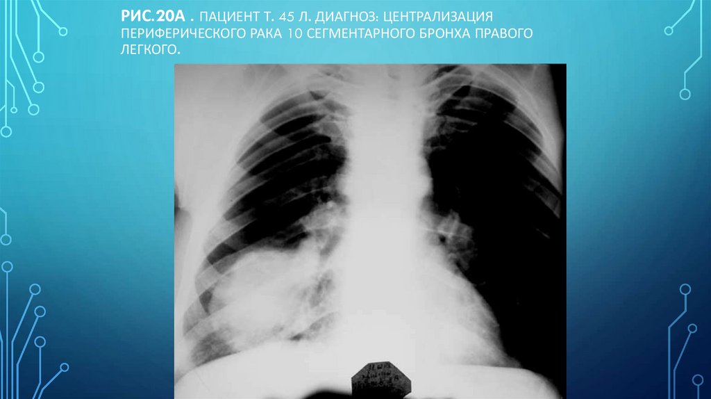 Рис.20а . Пациент Т. 45 л. Диагноз: Централизация периферического рака 10 сегментарного бронха правого легкого.