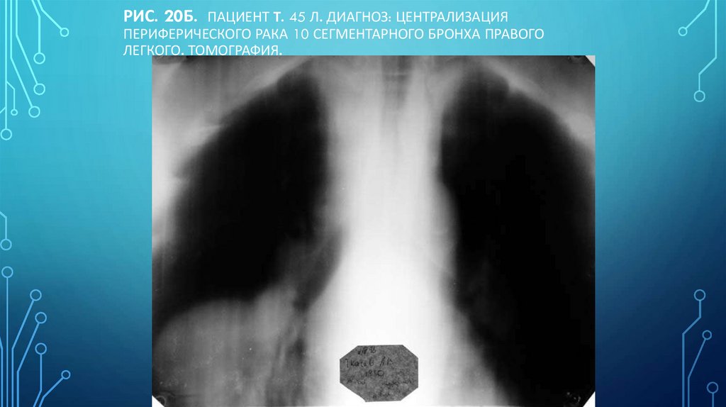 Рис. 20б. Пациент Т. 45 л. Диагноз: Централизация периферического рака 10 сегментарного бронха правого легкого. Томография.