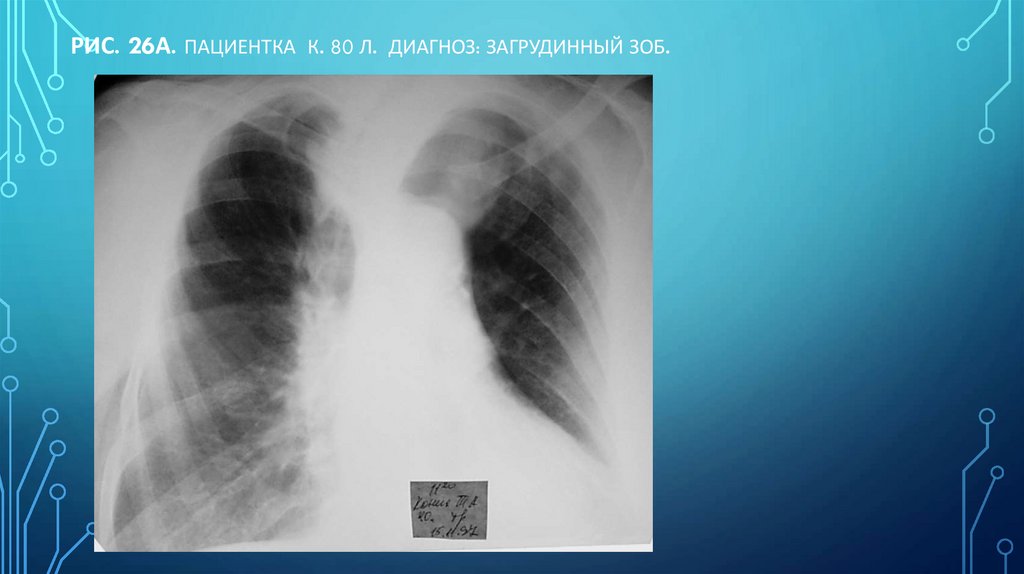 Рис. 26а. Пациентка К. 80 л. Диагноз: загрудинный зоб.