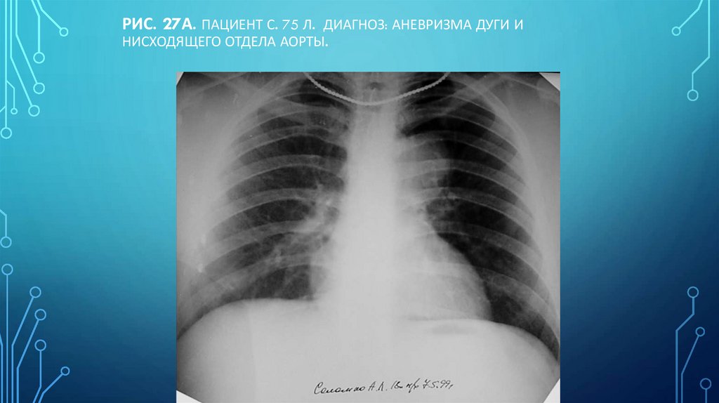 Рис. 27а. Пациент С. 75 л. Диагноз: Аневризма дуги и нисходящего отдела аорты.