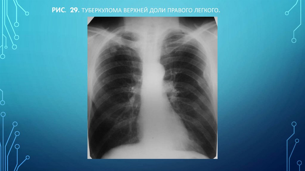 Рис. 29. Туберкулома верхней доли правого легкого.
