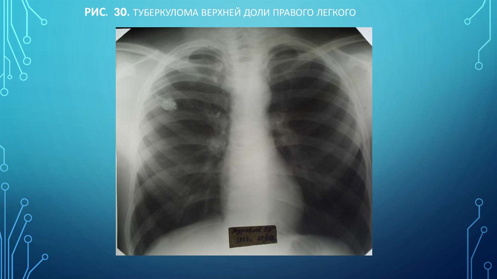 Рис. 30. Туберкулома верхней доли правого легкого