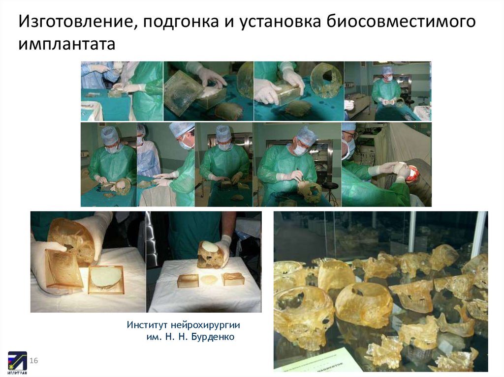 Изготовление, подгонка и установка биосовместимого имплантата