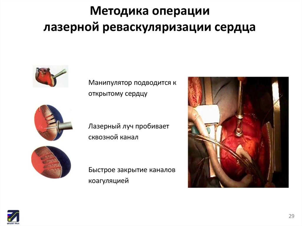 Методика операции лазерной реваскуляризации сердца
