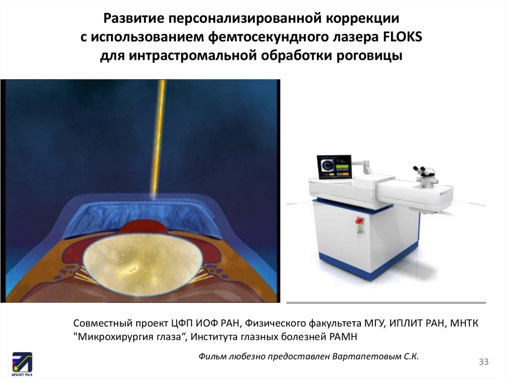 Развитие персонализированной коррекции с использованием фемтосекундного лазера FLOKS для интрастромальной обработки роговицы
