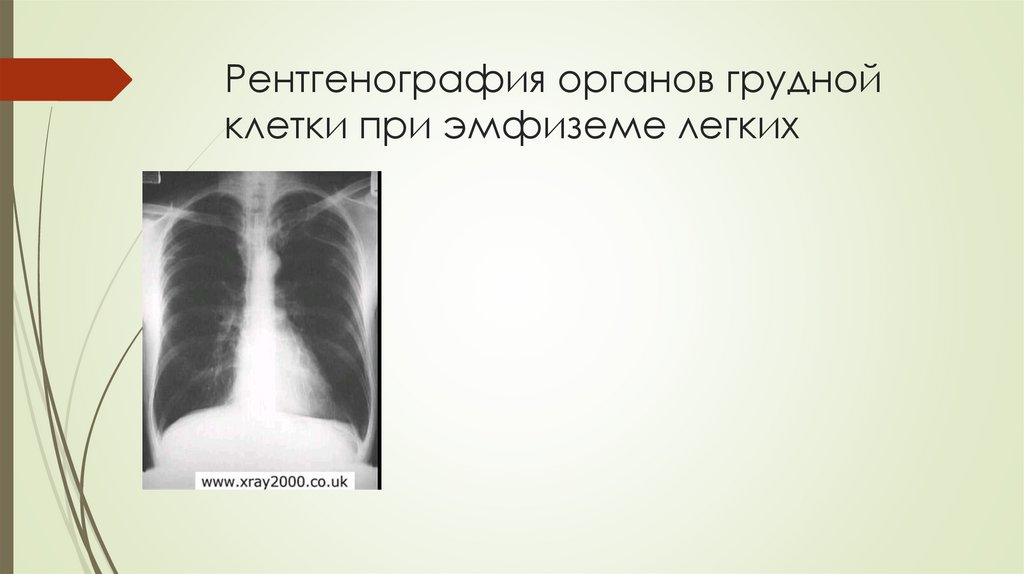 Рентгенография органов грудной клетки при эмфиземе легких