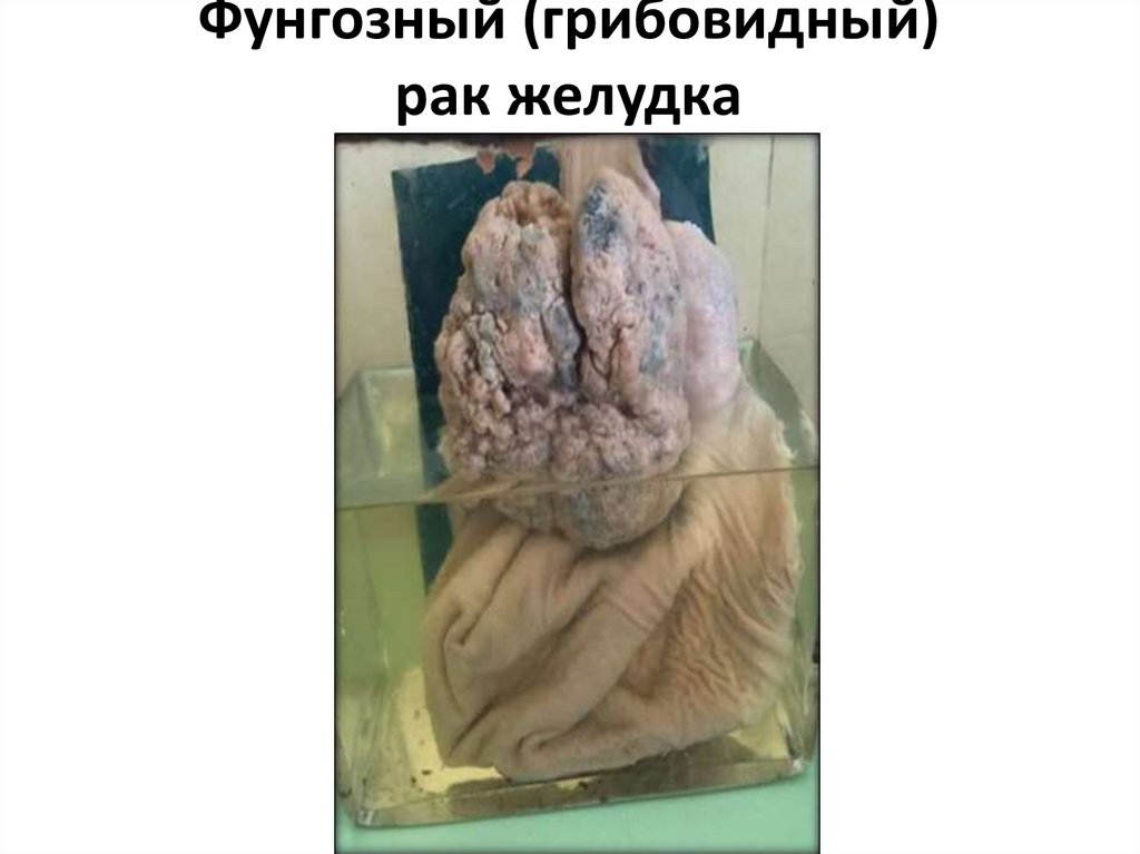 Фунгозный (грибовидный) рак желудка