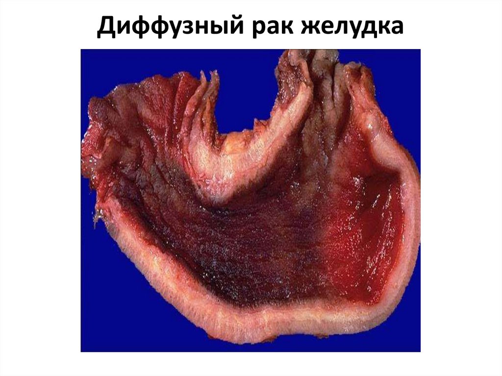 Диффузный рак желудка