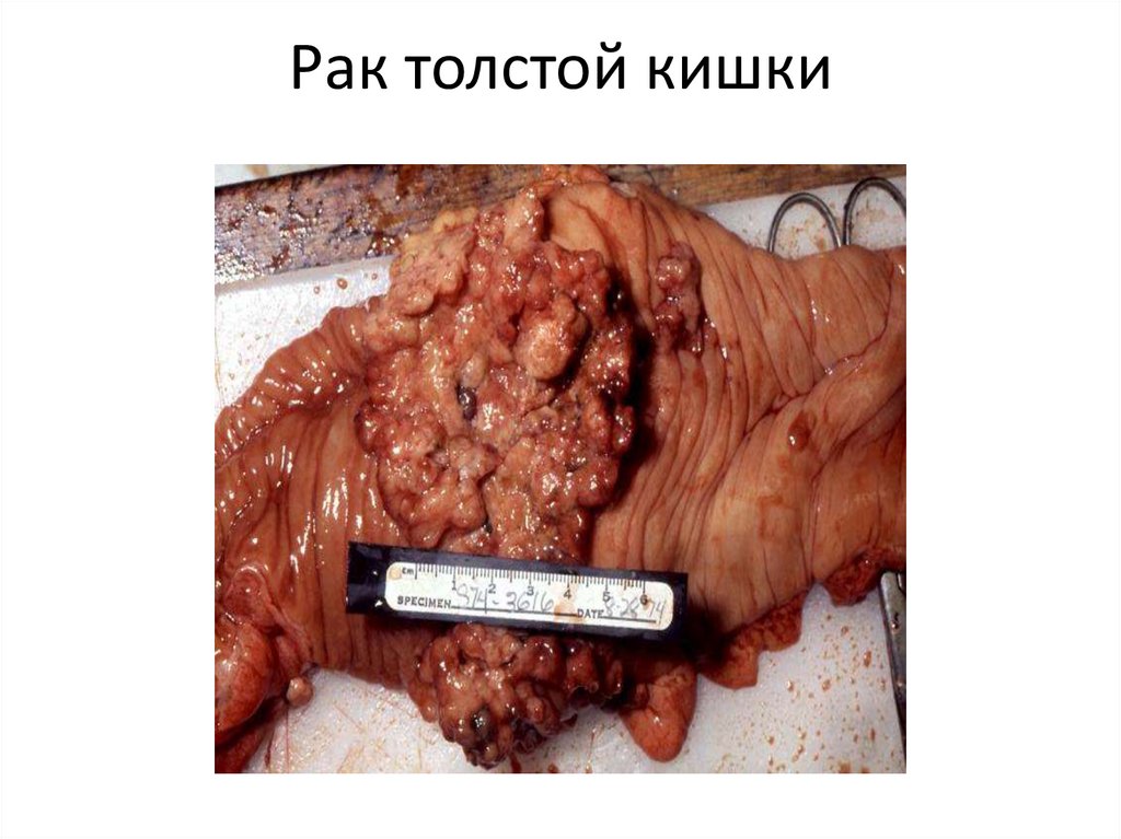 Рак толстой кишки