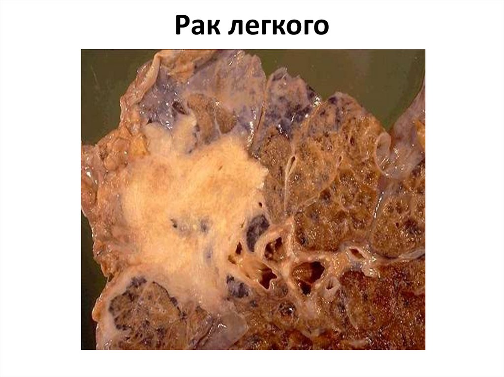 Рак легкого