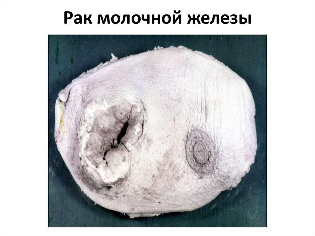 Рак молочной железы