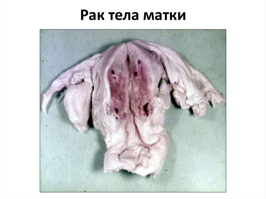 Рак тела матки